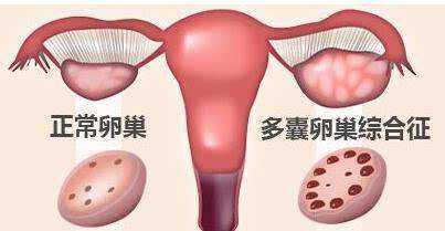 北京正规助孕费用_北京有靠谱做供卵的吗_备孕路上的拦路虎-多囊卵巢综合征